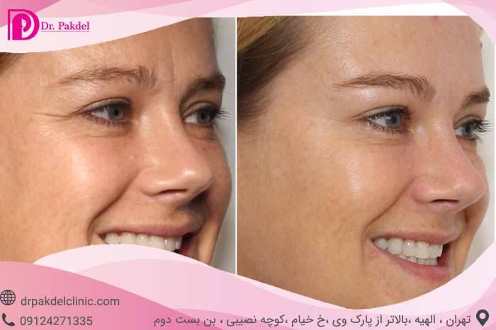 تزریق بوتاکس برای چه افرادی مناسب است؟کاربردها,قیمت