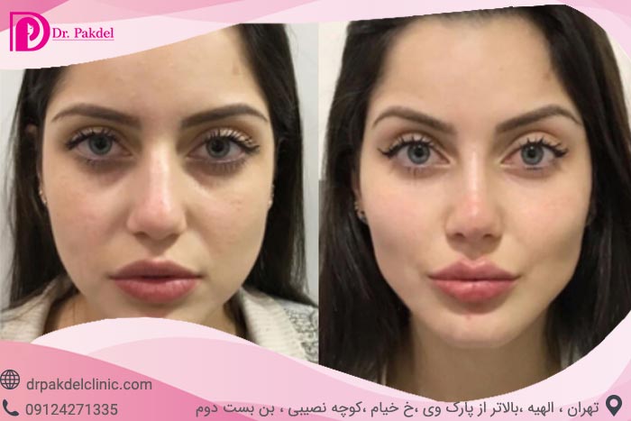لیفت شقیقه چگونه انجام می شود؟ انواع روش ها,مزایا,مراقبتها
